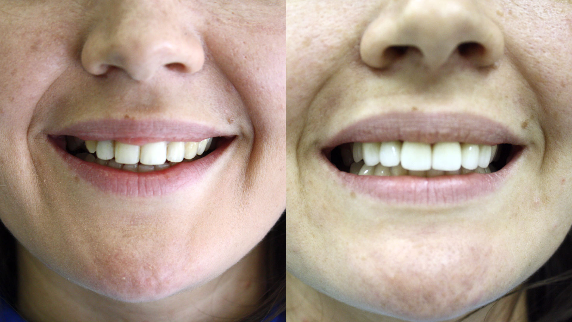 Ксения корнева зубы до и после фото